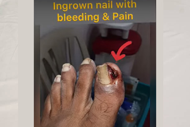 General surgery -Treatment for Ingrown Toenails in Bangalore - Manipal  Hospitals Whitefield